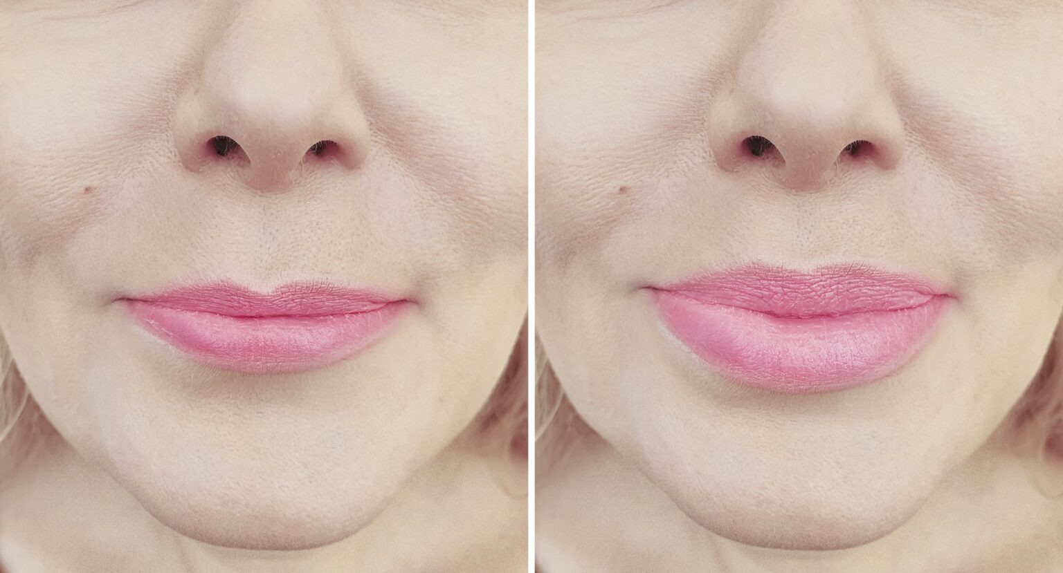 dr-krushel-dermal-filler-278272190_XL-85p-2000px