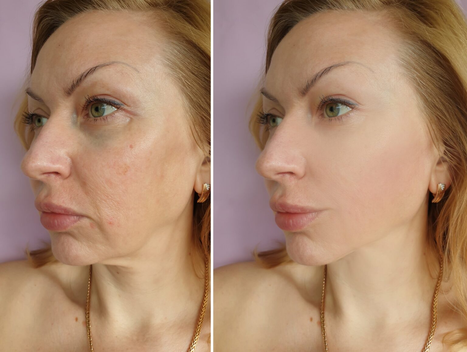 dr-krushel-sculptra-465000720_XL-2000px-85p